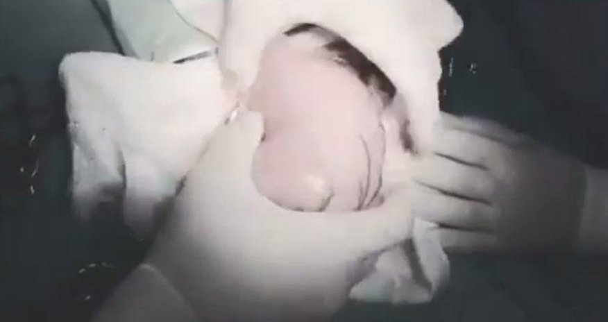 Azərbaycanda 5 yaşlı qızın mədəsindən böyük tük kütləsi çıxarılıb - VİDEO