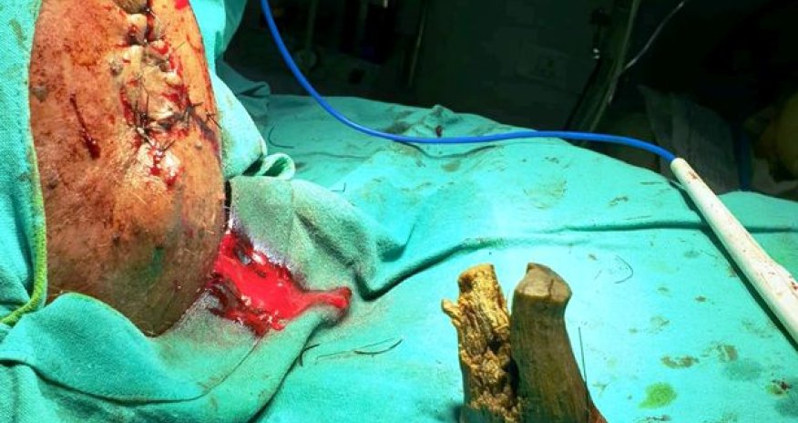 Kişi buynuz çıxartdı  - FOTOFAKT