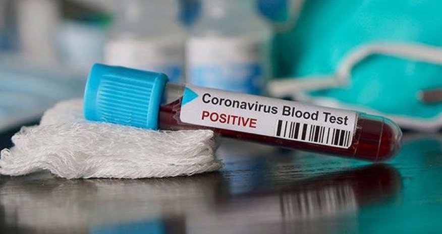 Azərbaycanda koronavirusdan ölənlərin sayı 21-ə çatdı