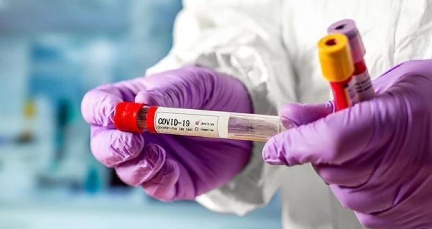 Zaur Əliyevdən koronovirusa yoluxmaların müəyyənləşdirilməsi ilə bağlı AÇIQLAMA