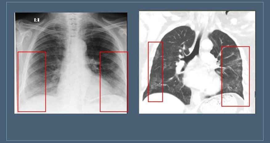 Insanları qorxudan “buzlu şüşə” nədir?