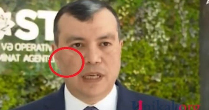 Sahil Babayevin xəstəliyinin adı bilindi — FOTO