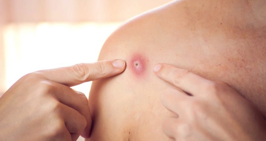 Britaniyada meymunçiçəyinə yoluxma sayı 106-ya yüksəlib