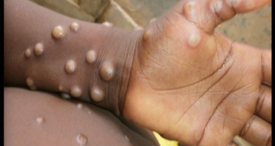 Meymunçiçəyindən ilk ölüm qeydə alındı