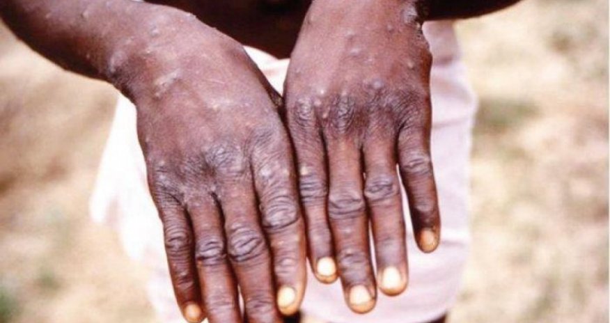 Vaşinqtonda meymunçiçəyinə yoluxma halı qeydə alınıb