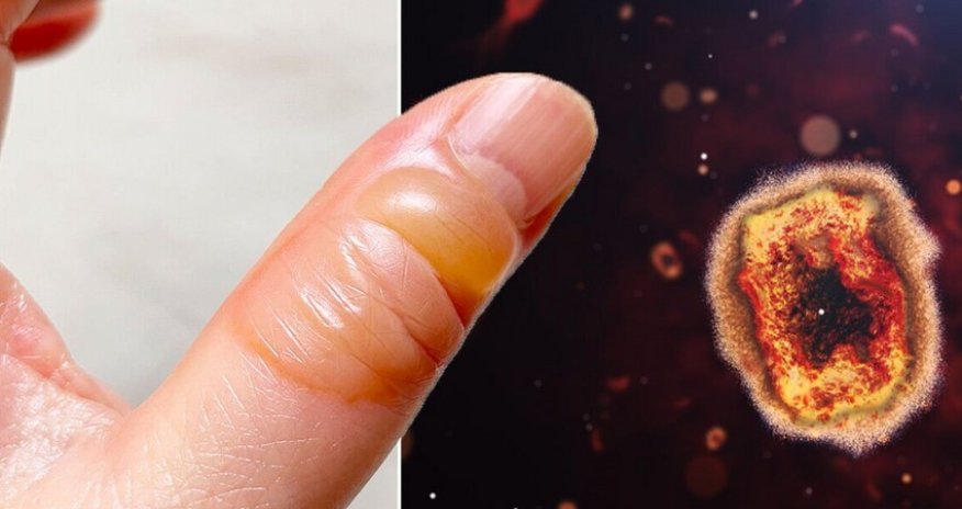 Gürcüstanda meymunçiçəyinə yoluxma ilə bağlı şübhəli hallar aşkarlanıb