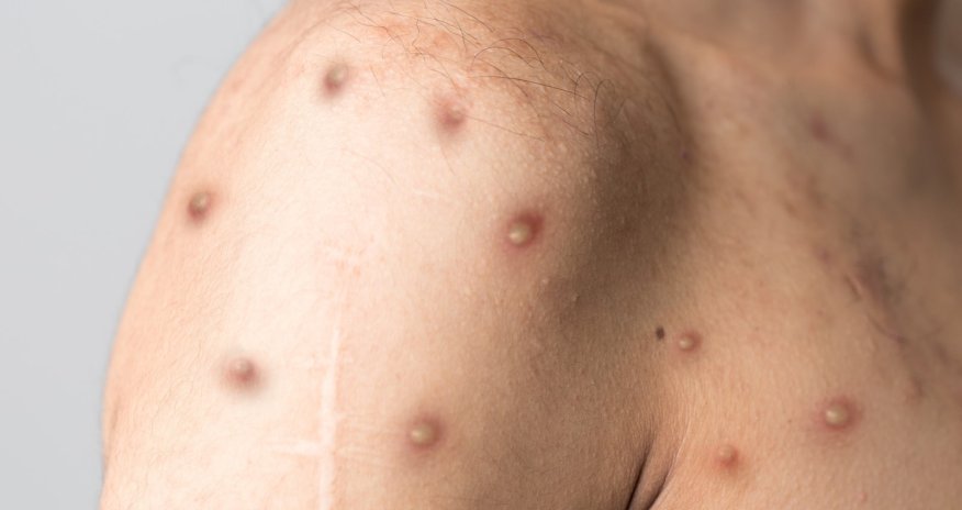 Daha bir Avropa ölkəsində meymunçiçəyi aşkarlandı