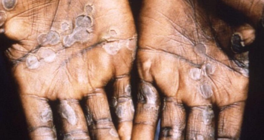 3 mindən çox meymunçiçəyinə yoluxma faktı var - Dünyada son vəziyyət