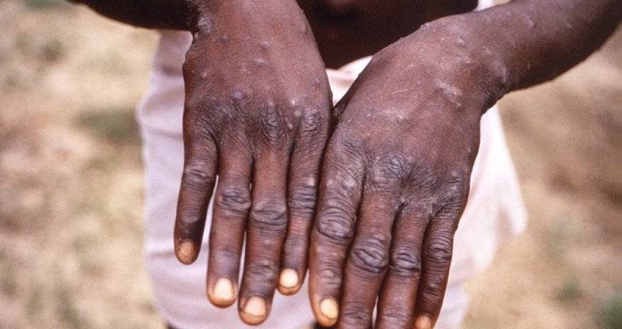 Bu ölkədə meymunçiçəyi aşkarlandı