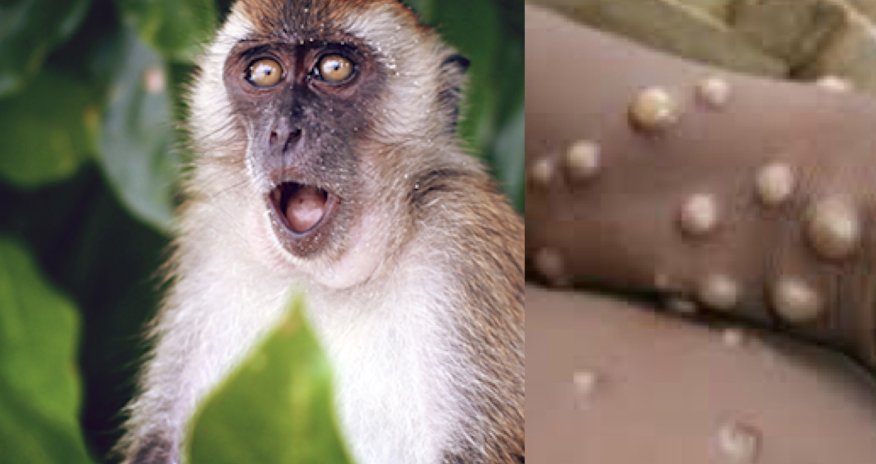 Meymunçiçəyinə yoluxanların sayı üç dəfə artaraq 4,5 min nəfər olub