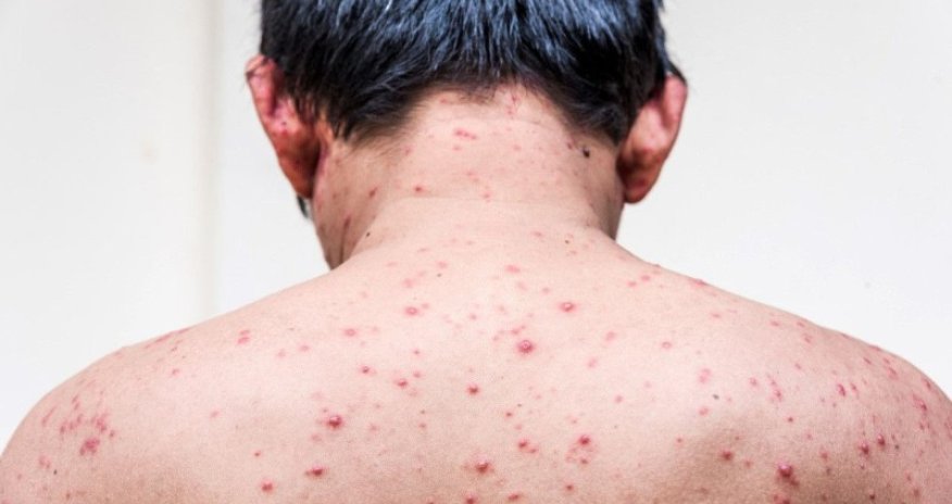 Avropada meymunçiçəyinin sayı artdı - RƏQƏMLƏR