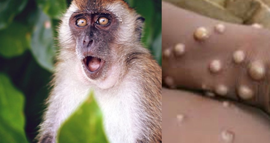 Bu ölkələrdə meymunçiçəyinə yoluxma AŞKARLANDI