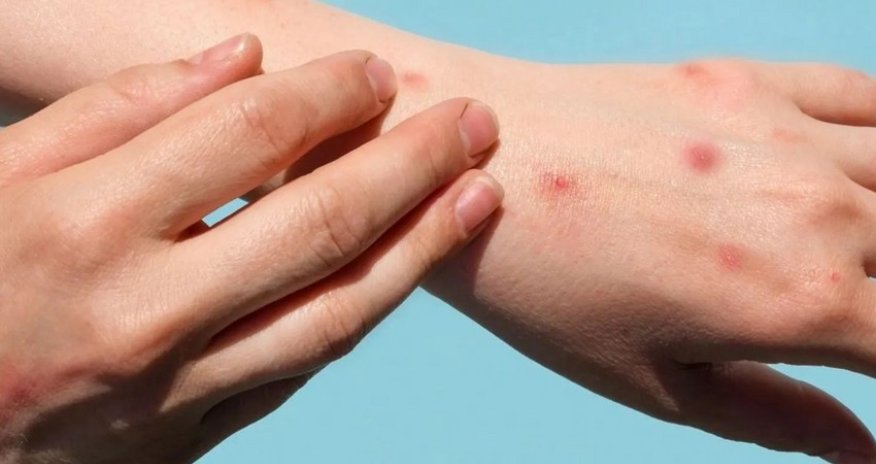 Rusiyada meymunçiçəyini aşkar edən test hazırlanıb