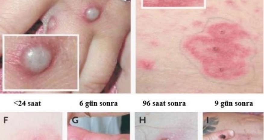 No monkeypox cases recorded in Azerbaijan - OFFICIAL