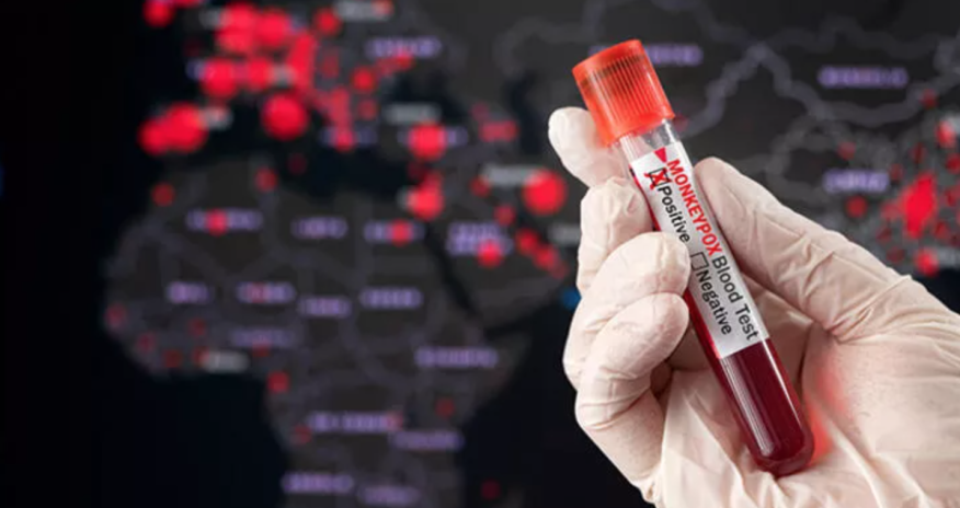Meymunçiçəyi kişilər arasında çox yayılıb  - ÜST-ün mətbuat konfransından detallar