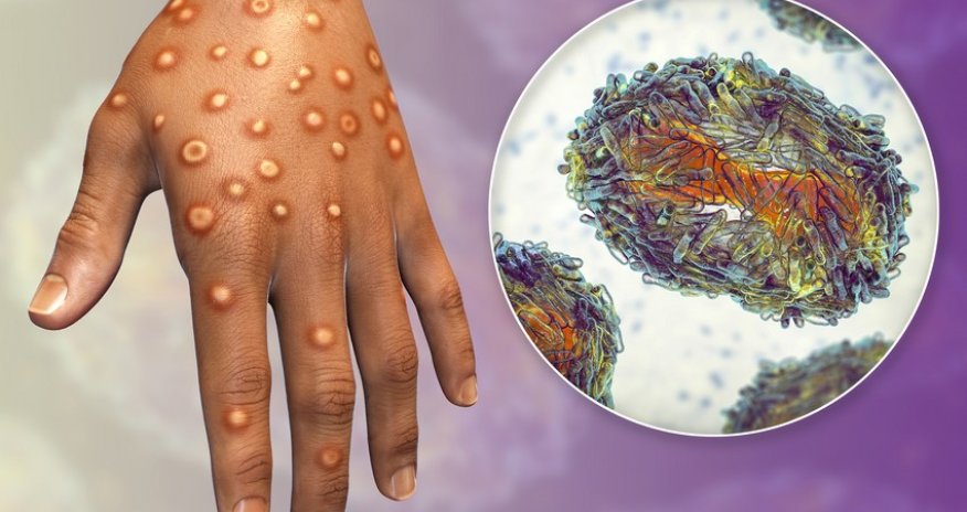 No monkeypox cases recorded in Azerbaijan