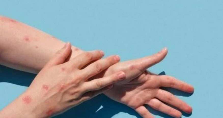 Bu ölkədə meymunçiçəyinə ilk yoluxma qeydə alındı