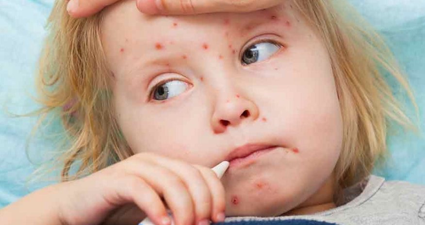 Ermənistanda qızılcaya yoluxma halları artıb