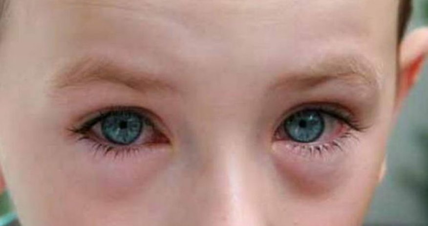 Koronavirusun uşaqlar arasında yayılan yeni variantının əlamətləri açıqlandı