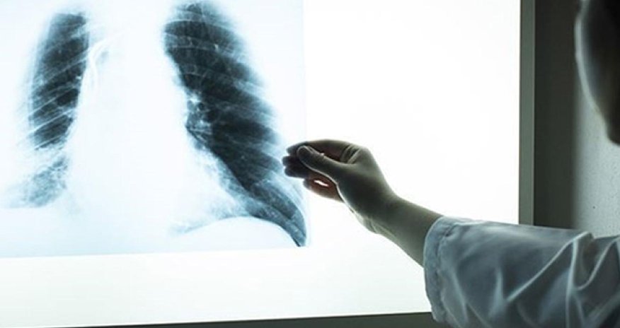 Polşada legionella bakteriyasından ölənlərin sayı artıb