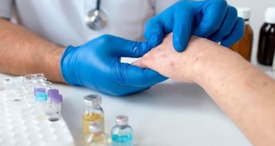 Azərbaycanda bir universitetin 8 tələbəsi qızılcaya yoluxub