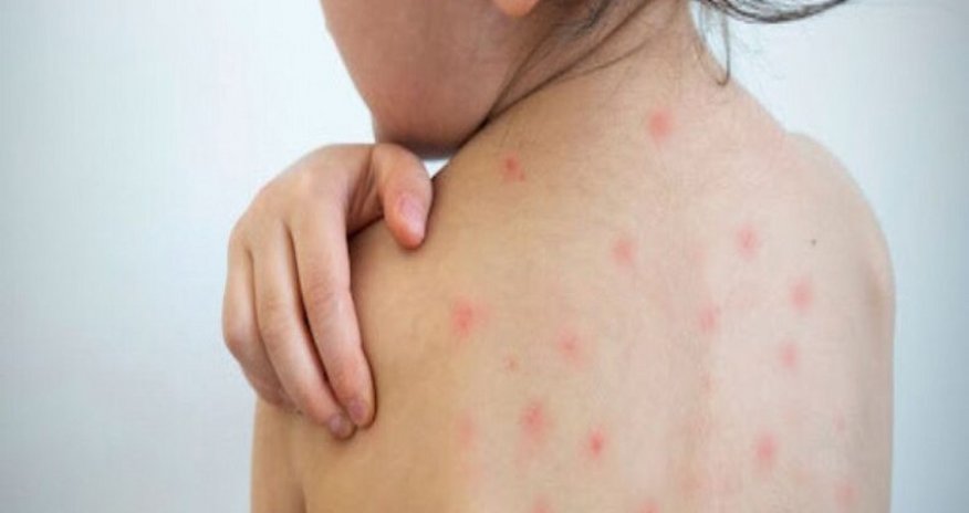 Qızılca ilə bağlı valideynlərə çağırış edilib