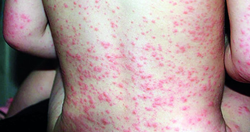 ÜST əhalini qızılca peyvəndini vurdurmağa çağırıb