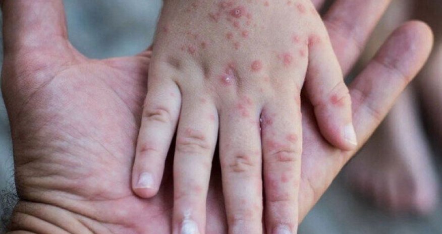 Avropa və Mərkəzi Asiyada 31 minə yaxın adam qızılcaya yoluxub