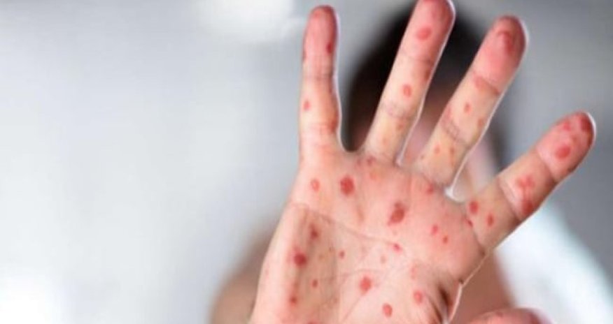 ÜST qızılca ilə bağlı təcili vaksinasiya çağırışı edib