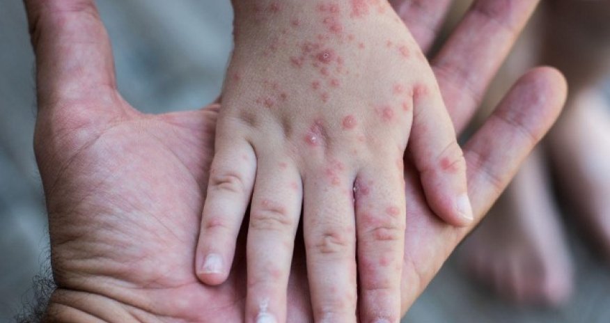 Ermənistanda qızılcaya yoluxanların sayı artıb