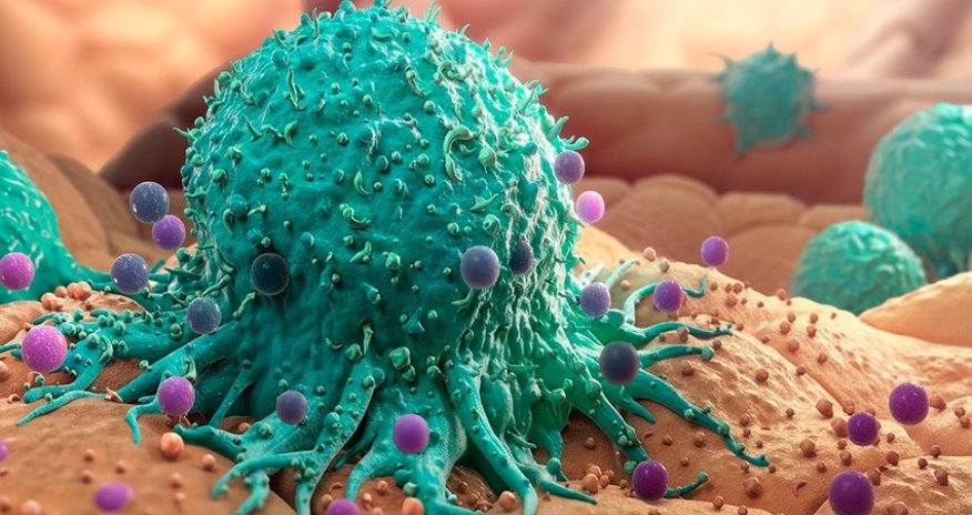 Gürcüstanda bütün xərçəng xəstələrinin müalicəsini dövlət maliyyələşdirəcək