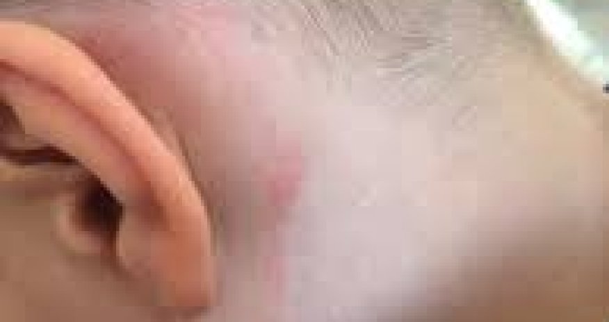 Qonşu ölkədə 2 mindən çox uşağı gənə dişlədiyi üçün xəstəxanaya müraciət edib