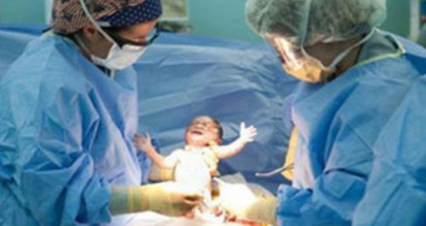 Türkiyədə siam əkizləri uğurlu əməliyyatdan sonra ayrılıb