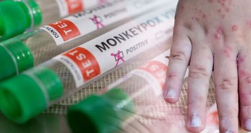 Afrikada meymunçiçəyi epidemiyası sürətlə yayılır