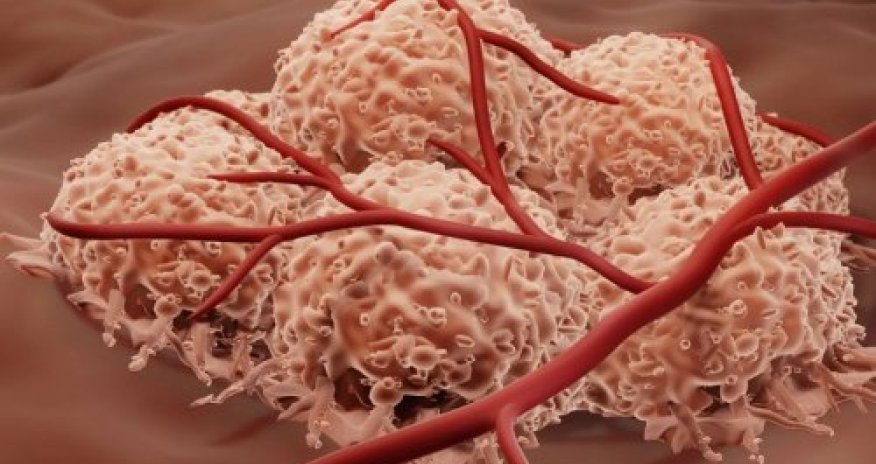 Rusiyanın xərçəng dərmanı testin birinci mərhələsindən keçib