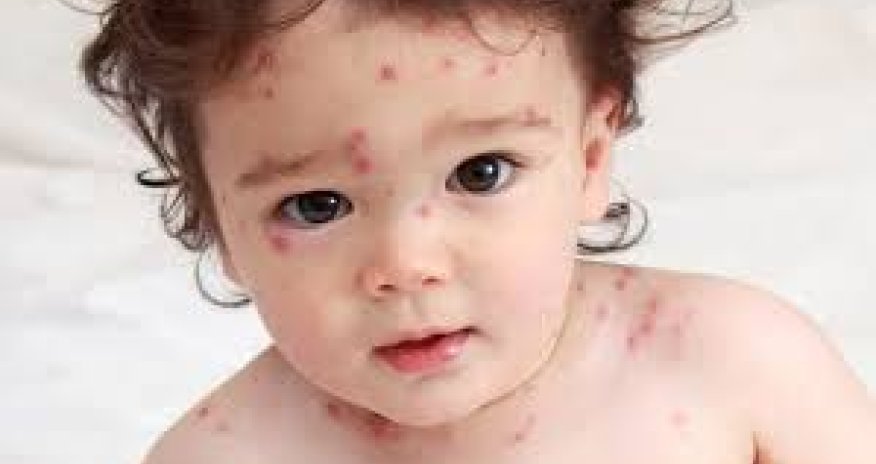 Suçiçəyi xəstəliyinə yoluxanların sayı azalıb