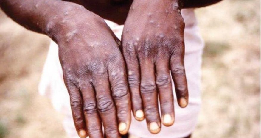 ВОЗ заявила о рекордном уровне заболеваемости mpox за 22 месяца