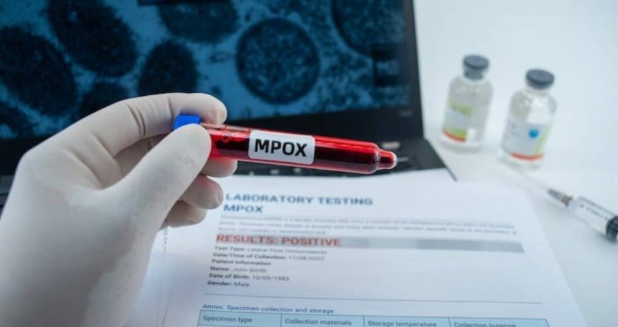 В США выявили первый случай заражения человека новым штаммом оспы обезьян