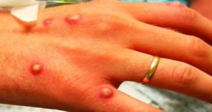 ВОЗ: Оспа обезьян продолжает представлять глобальную угрозу здоровью