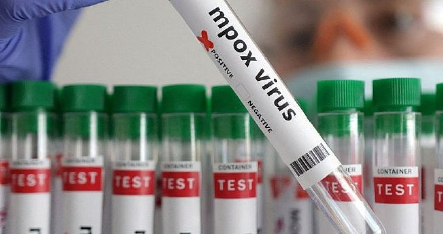 Azərbaycanda bir nəfər meymunçiçəyinə yoluxub -Rəsmi