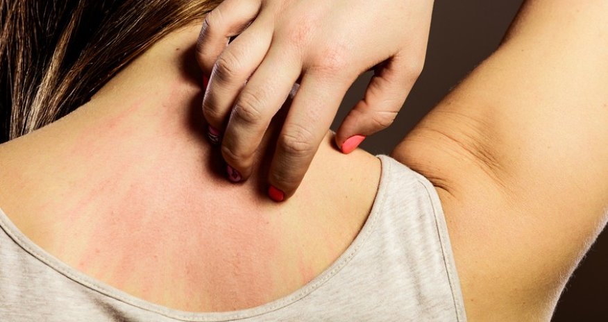 В Британии разразилась эпидемия необычной чесотки