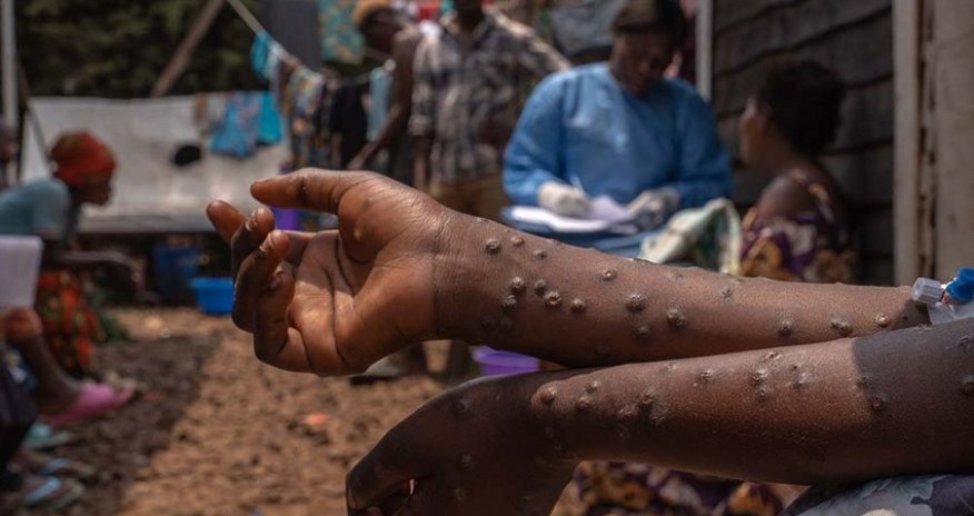 Uqandada meymunçiçəyinə yoluxanların sayı 4,8 mini keçib