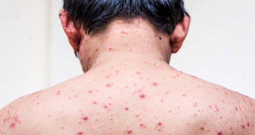 Azərbaycanda suçiçəyinə yoluxma sayı artıb - RƏSMİ