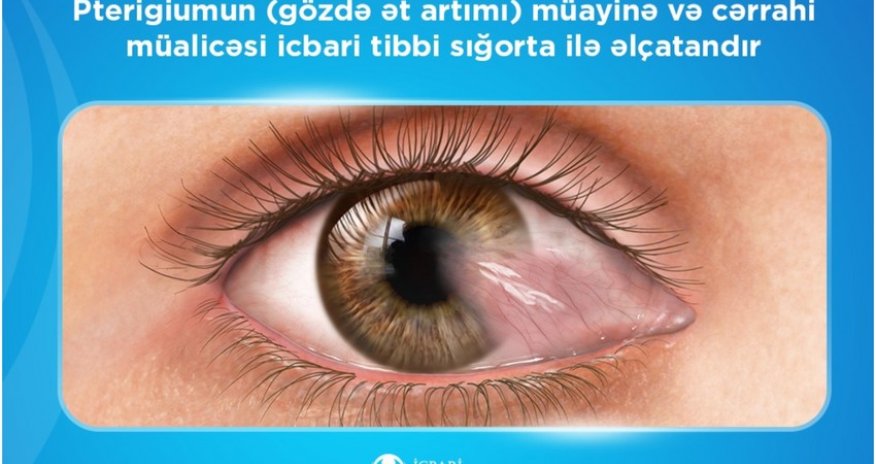 Pterigiumun cərrahi müalicəsi üzrə 2 minə yaxın əməliyyat icra olunub &ndash; İTSDA