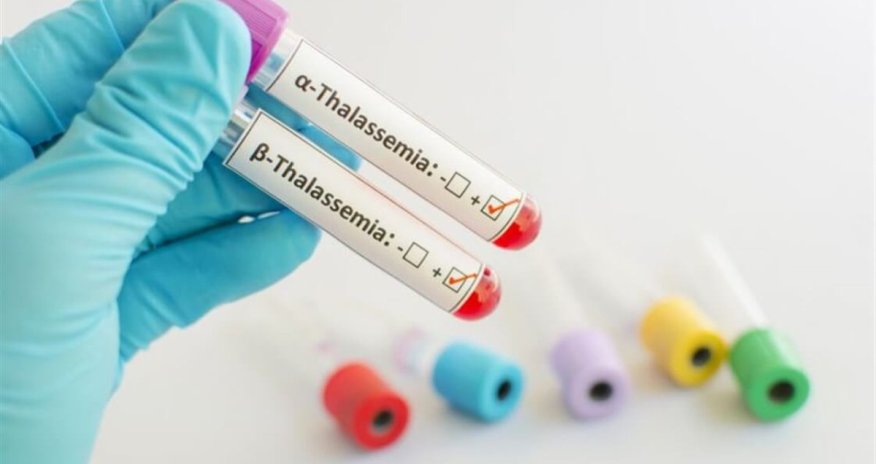 A bone marrow transplant only complete cure for some thalassemia cases