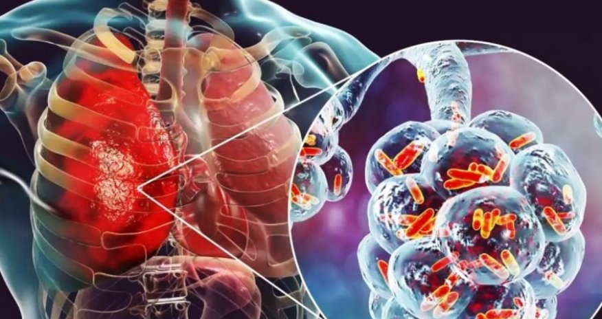 Ötən il pnevmoniyadan ölən şəxslərin sayı açıqlanıb