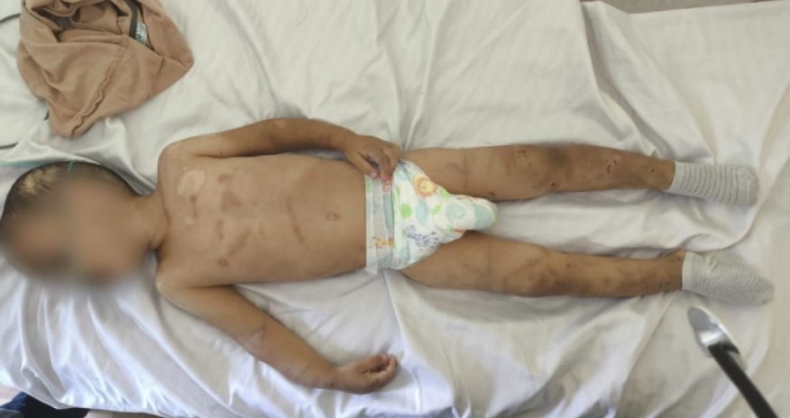 Valideynləri tərəfindən döyülən körpəsüni nəfəs aparatına qoşuldu