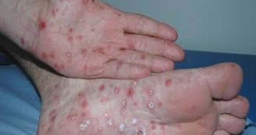 Konqoda Ebola epidemiyası: yoluxanların sayı 5 656-ya çatıb